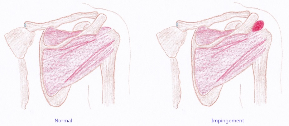 Impingement