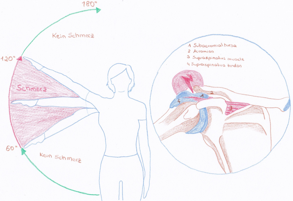 Impingement