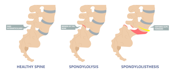 Spondylolysis Spondylolysis